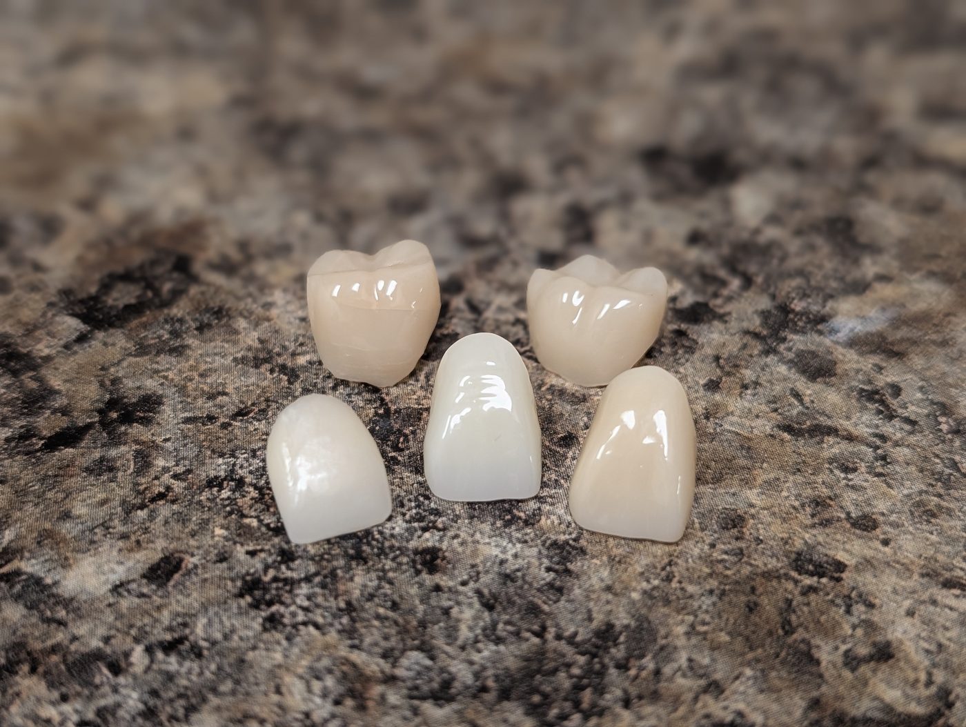 Custom ceramic dental crowns crafted at Precise Dental in Tucson